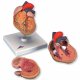 Model srdce s hypertrofií levé komory - 2 části