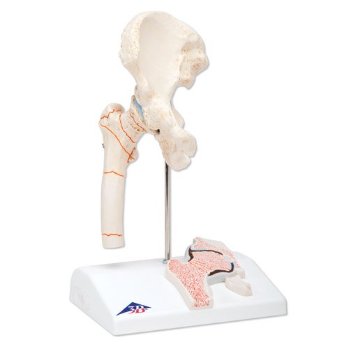 Zánět kostních kloubů - model