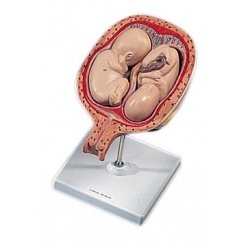 Plod dvojčat v pátém měsíci těhotenství